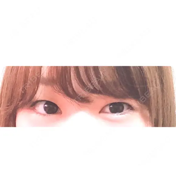 二重切開 神野美容形成外科クリニック BEFORE メイン用