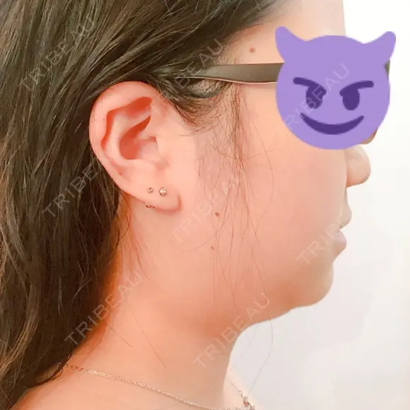 脂肪吸引（顔） 湘南美容クリニック 渋谷院 BEFORE メイン用