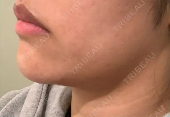 脂肪溶解注射（顔） リエンジャン整形外科 江南店 BEFORE メイン用