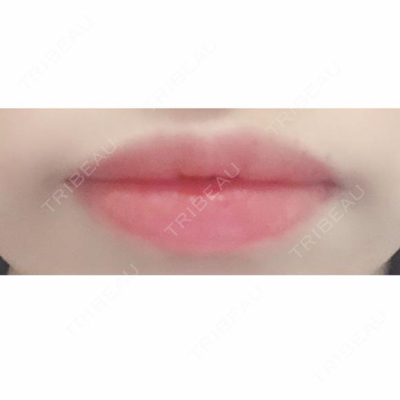 口唇縮小術 B-LINE CLINIC 池袋院 BEFORE メイン用