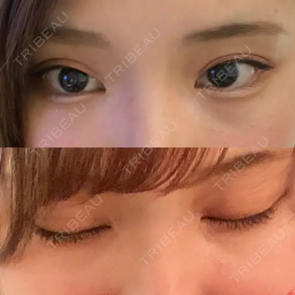 二重埋没 ビスポーククリニック 福岡院 BEFORE メイン用