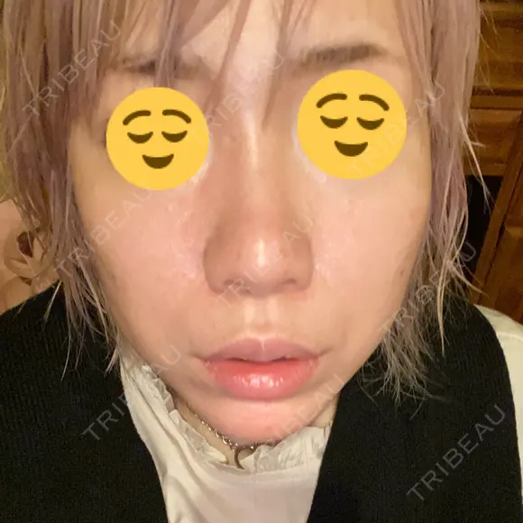 隆鼻術 品川美容外科 名古屋院 BEFORE メイン用
