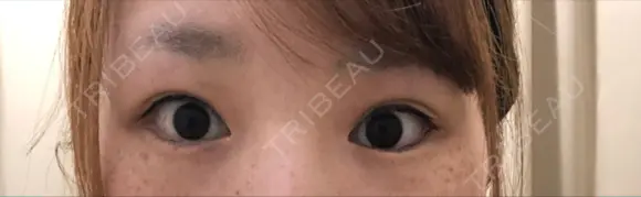 二重埋没 湘南美容クリニック 所沢院 BEFORE メイン用