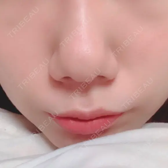 隆鼻術 / 鼻尖形成（切開） / 鼻中隔延長（切開） / 小鼻縮小（切開） / 軟骨移植 / 骨切幅寄せ / 鼻尖縮小 / 真皮移植 表参道スキンクリニック 名古屋院（DAILY SKIN CLINIC提携院） BEFORE メイン用