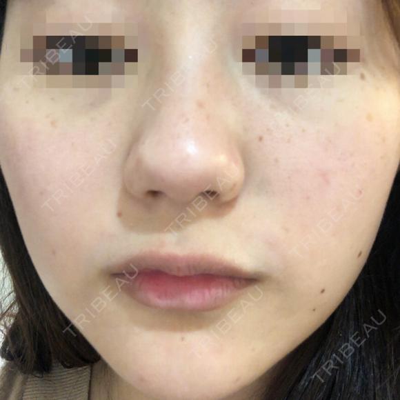 ピコレーザートーニング（美白・肝斑） UB CLINIC 銀座 BEFORE メイン用