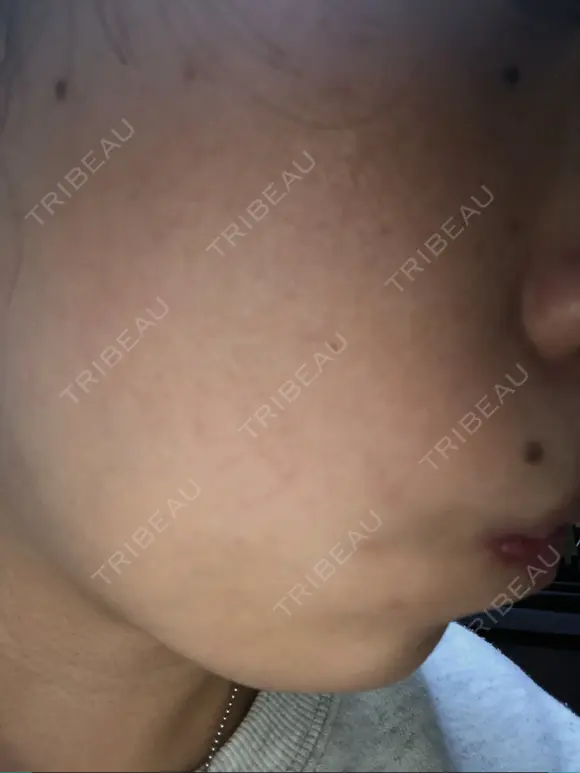 ピーリング（ニキビ・毛穴） 自由が丘クリニック BEFORE メイン用