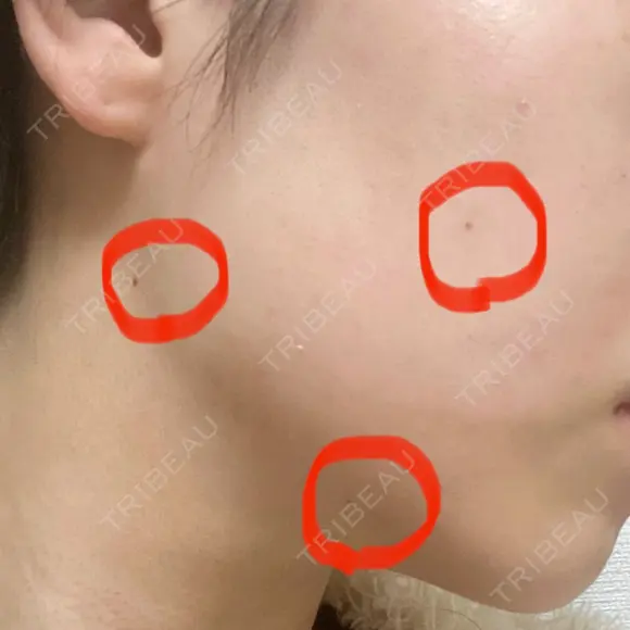 ほくろ・いぼ切除（肌） 赤坂メディカルMクリニック BEFORE メイン用