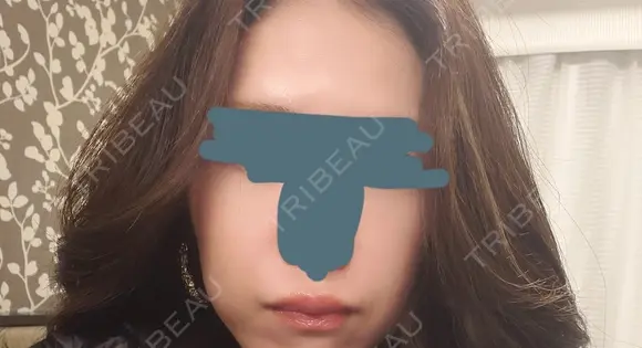 肌ヒアルロン酸注入（たるみ・シワ改善） 表参道スキンクリニック 表参道院 BEFORE メイン用