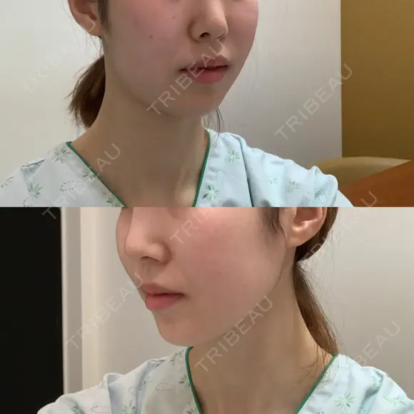 骨切り（あご） / 骨削り（エラ） / 骨削り（頬） id（アイディ）美容外科 BEFORE メイン用