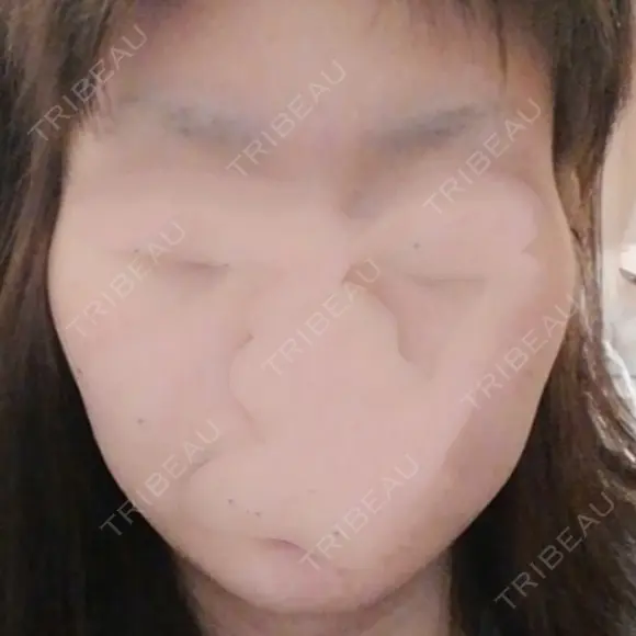 骨削り（頬） / 脂肪注入（肌） ボンディ美容整形外科（旧リオン整形外科） BEFORE メイン用