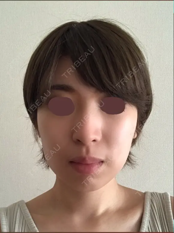 脂肪溶解注射（顔） 赤坂プレミアクリニック BEFORE メイン用