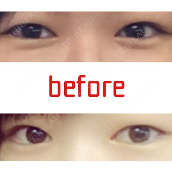 二重埋没 湘南美容クリニック 大宮院 BEFORE メイン用