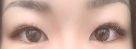 二重埋没 / 上まぶたの脂肪取り TCB東京中央美容外科 江坂院 BEFORE メイン用