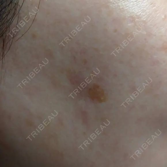 YAGレーザー 新宿美容外科クリニック 横浜院 BEFORE メイン用