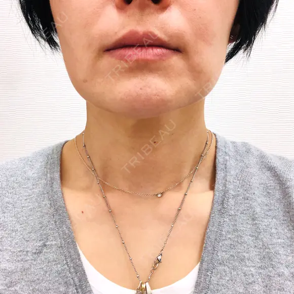 バッカルファット除去 TCB東京中央美容外科 堺院 BEFORE メイン用