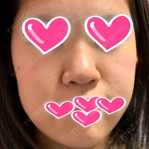 隆鼻術 / 鼻尖形成（切開） / 鼻中隔延長（切開） / 小鼻縮小（切開） / 眉間プロテーゼ ラミチェ美容整形外科 BEFORE メイン用