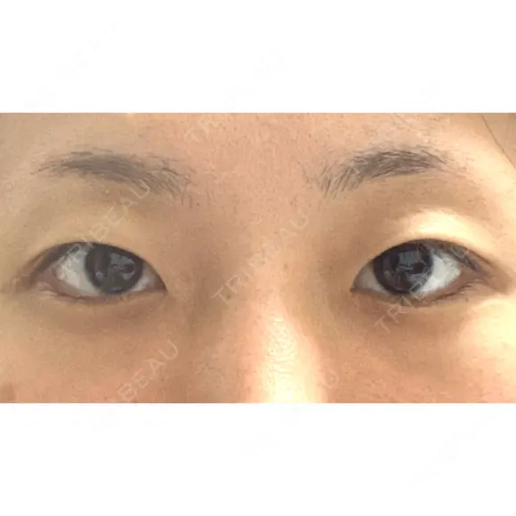 二重埋没 湘南美容クリニック 松山院 BEFORE メイン用