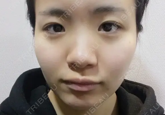 二重埋没 / 目頭切開 / 眼瞼下垂（切開） / 隆鼻術 / 鼻尖形成（切開） / 鼻中隔延長（切開） / 骨切り（あご） / 骨削り（エラ） / 骨削り（頬） / 骨切幅寄せ ボンディ美容整形外科（旧リオン整形外科） BEFORE メイン用