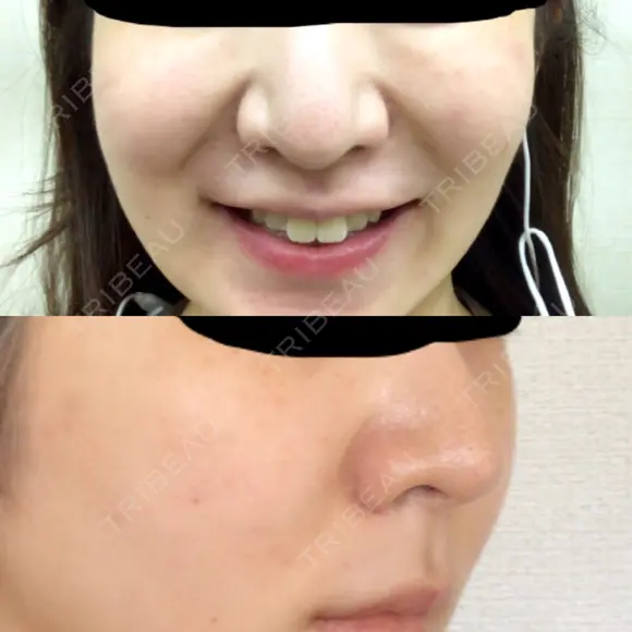 メーラーファット除去 WOM CLINIC GINZA （ワム クリニック ギンザ） BEFORE メイン用