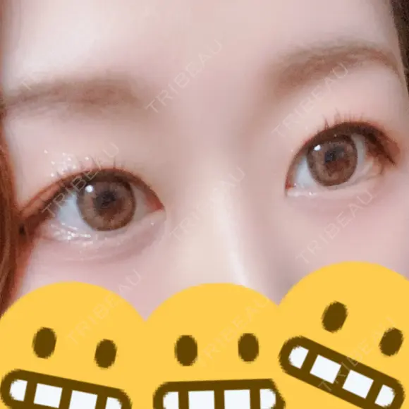 二重切開 こうべ花時計クリニック BEFORE メイン用