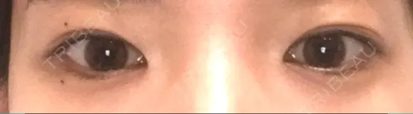 目頭切開 湘南美容クリニック 金沢院 BEFORE メイン用