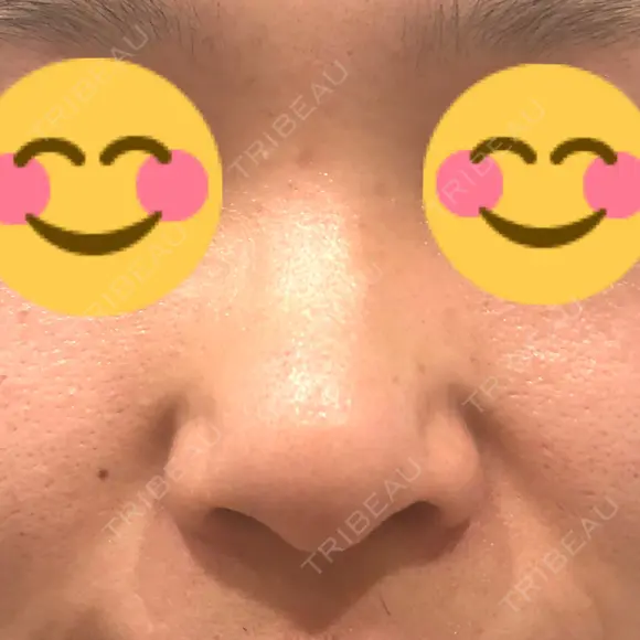 隆鼻術 たにまちクリニック BEFORE メイン用