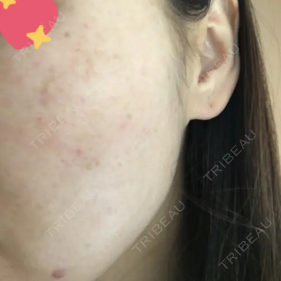 美肌レーザー / シミ取りレーザー / ピコレーザートーニング（美白・肝斑） 湘南美容クリニック 秋葉原院 BEFORE メイン用
