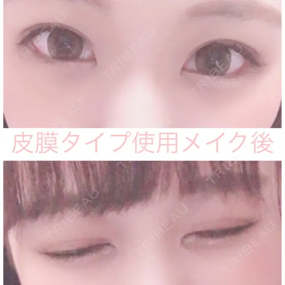 二重埋没 湘南美容クリニック 赤坂見附院 BEFORE メイン用