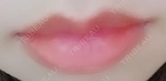 口唇縮小術 B-LINE CLINIC 池袋院 BEFORE メイン用