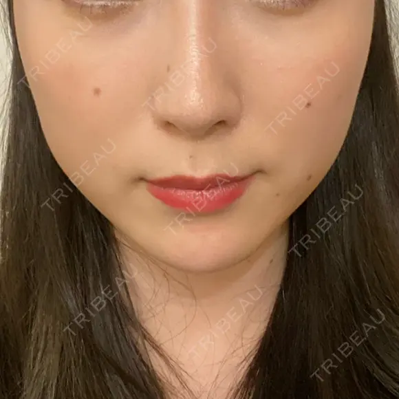 ハイフ（顔） Zetith Beauty Clinic 銀座院 BEFORE メイン用