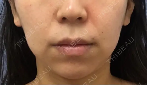 バッカルファット除去 / 脂肪吸引（顔） 湘南美容クリニック 那覇院 BEFORE メイン用