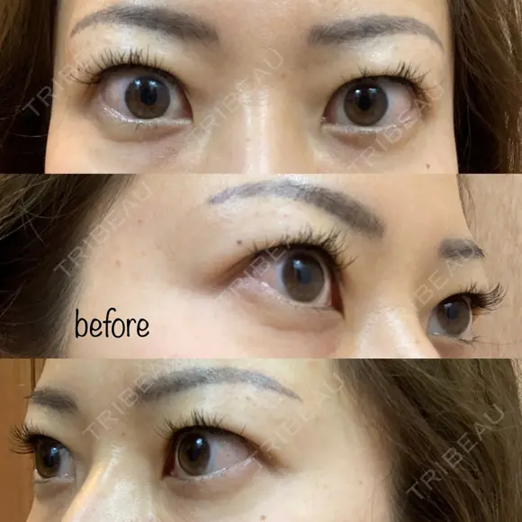 眉下切開 湘南美容クリニック 秋葉原院 BEFORE メイン用