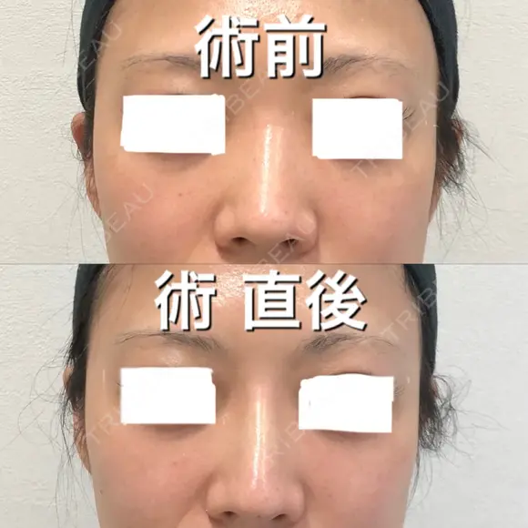 ヒアルロン酸注入（鼻） BIANCA銀座 BEFORE メイン用