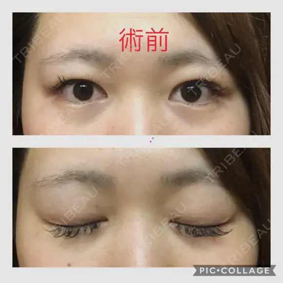 二重埋没 城本クリニック 四日市院 BEFORE メイン用