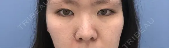 目頭切開 / 鼻尖形成（切開） / 鼻中隔延長（切開） 湘南美容クリニック 金沢院 BEFORE メイン用