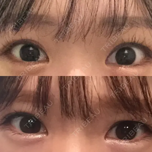 二重埋没 湘南美容クリニック 宇都宮院 BEFORE メイン用