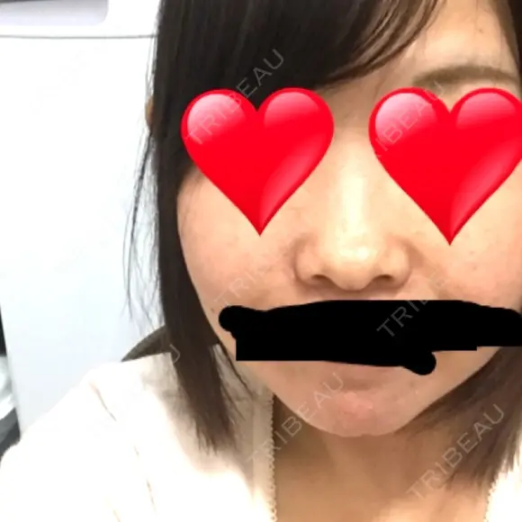 小鼻縮小（切開） / その他（鼻） 湘南メディカル記念病院（両国） BEFORE メイン用