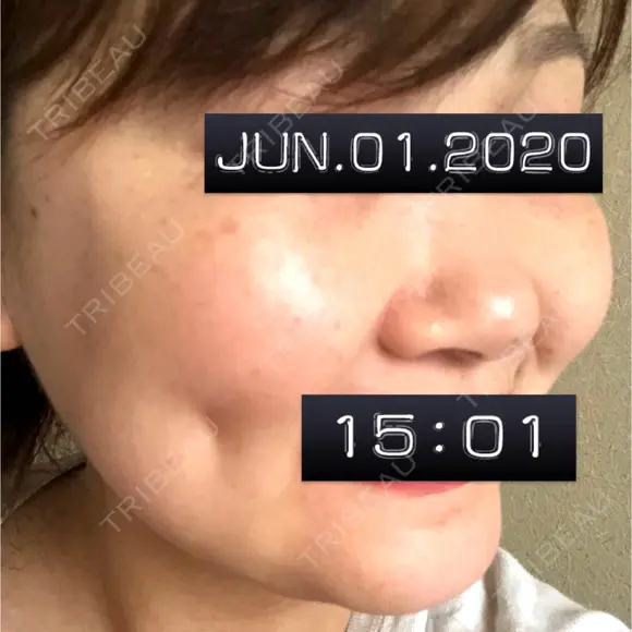 脂肪溶解注射（顔） / 脂肪溶解注射（二の腕） / ボトックス（肩） / その他（ボディ） 品川スキンクリニック京都院 BEFORE メイン用