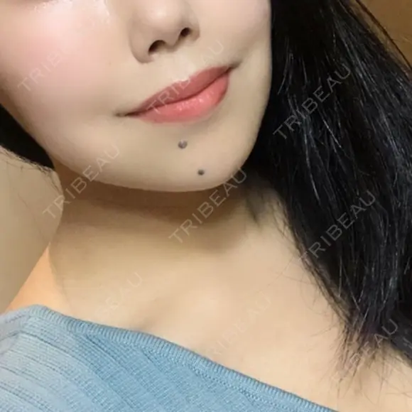 ヒアルロン酸注入（唇） / ボトックス（口角） id美容クリニック 銀座院 BEFORE メイン用