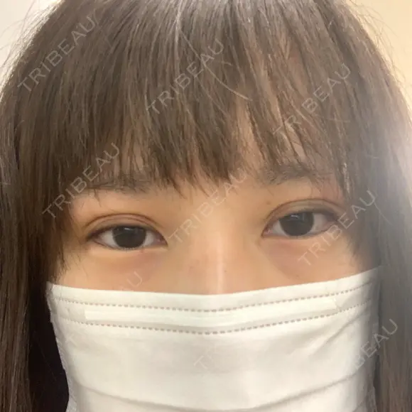 二重埋没 湘南美容クリニック 赤坂見附院 BEFORE メイン用