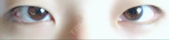 二重埋没 植村美容外科 BEFORE メイン用