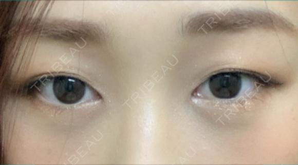 二重埋没 湘南美容クリニック 西宮北口院 BEFORE メイン用