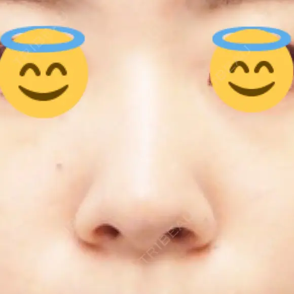 鼻尖縮小 / ヒアルロン酸注入（鼻） 東京ヒルズクリニック 新宿院 BEFORE メイン用