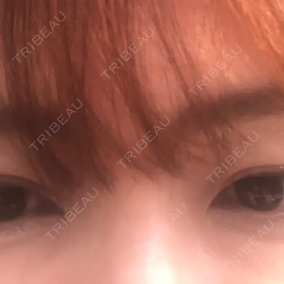 クマ治療 / ヒアルロン酸注入（涙袋） プラストクリニック BEFORE メイン用