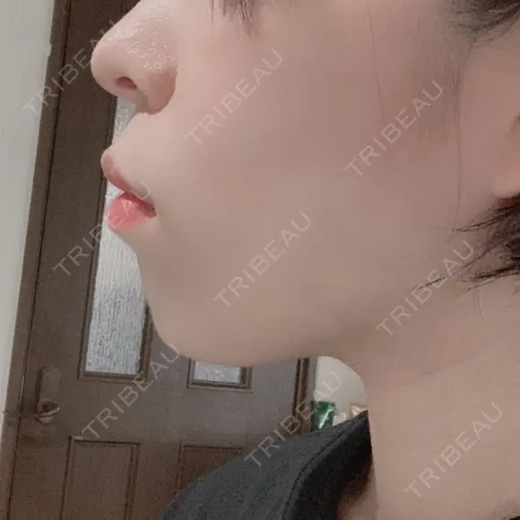 ガミースマイル手術 / 矯正（ワイヤー） / セラミック / ホワイトニング ラ・ブージュデンタルクリニック BEFORE メイン用