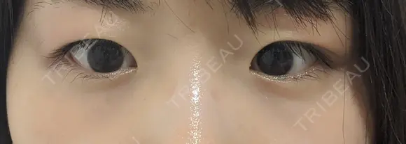 二重切開 / 目頭切開 / 眼瞼下垂（切開） / 目尻切開 湘南美容クリニック 大阪堺東院 BEFORE メイン用