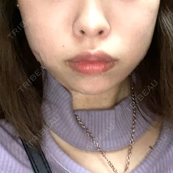 脂肪溶解注射（顔） 赤坂プレミアクリニック BEFORE メイン用