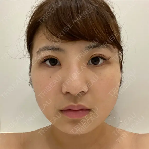 ヒアルロン酸注入（鼻） 銀座TAクリニック BEFORE メイン用