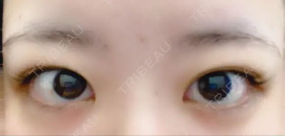 二重埋没 湘南美容クリニック 那覇院 BEFORE メイン用