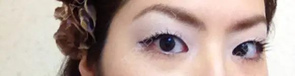 二重埋没 / 目頭切開 / 上まぶたの脂肪取り 十仁美容整形 BEFORE メイン用